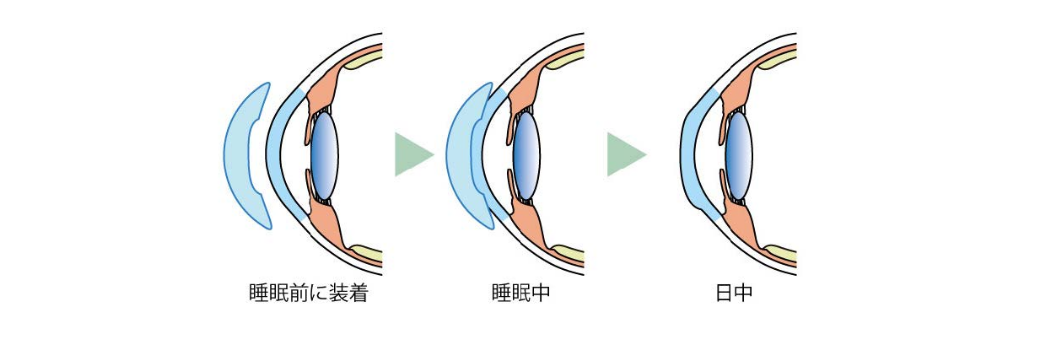 オルソケラトロジーによる予防