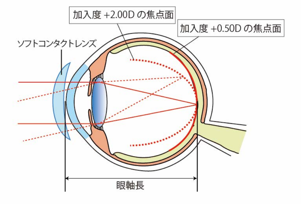 多焦点ソフトコンタクトレンズによる予防